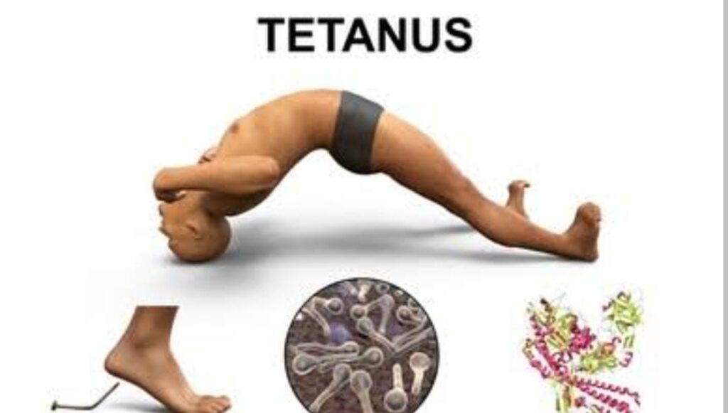 emergency treatment tetanus(टिटनस)